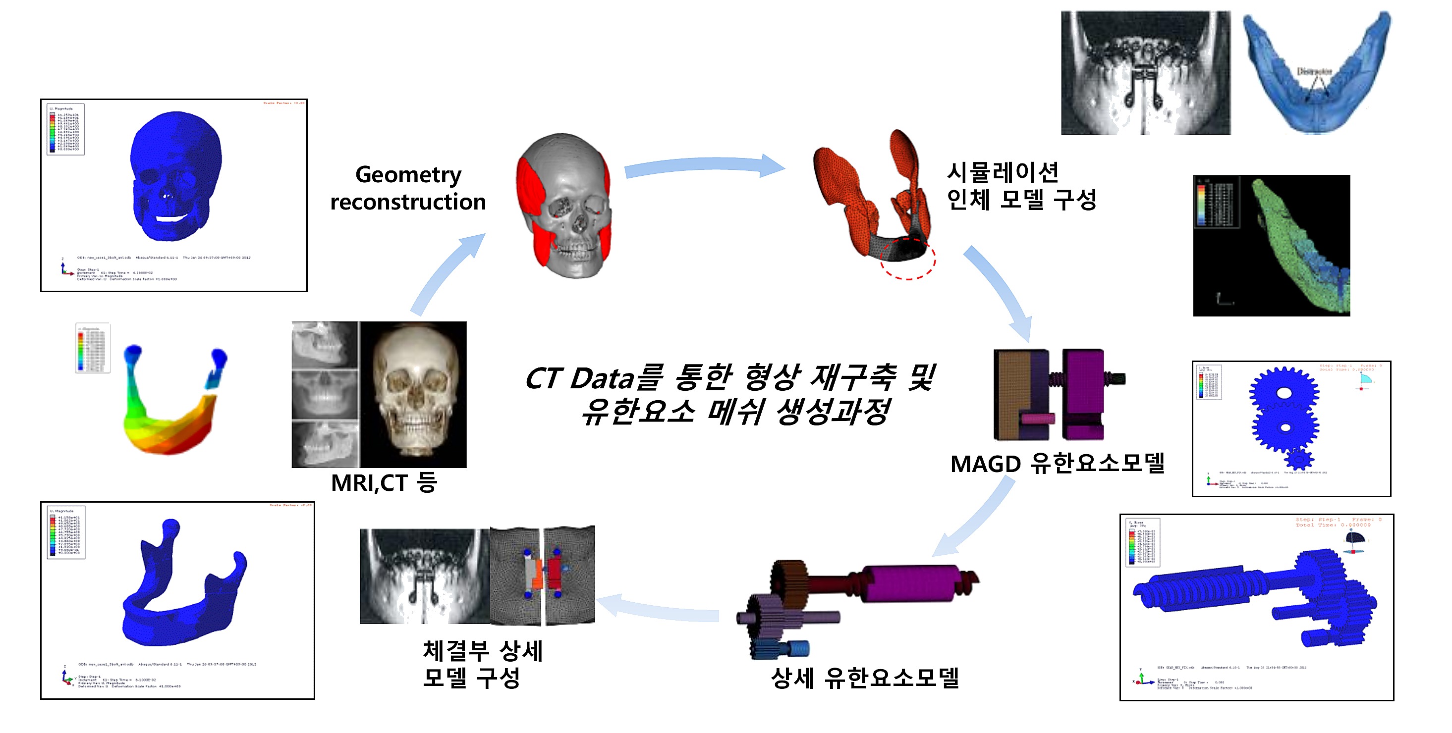 하악 이부확장 신장술